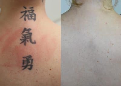 Vorher-Nachher-Tattooentfernung