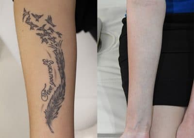 Vorher-Nachher-Tattooentfernung