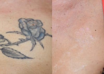 Vorher-Nachher-Tattooentfernung