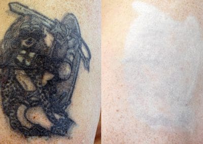 Vorher-Nachher-Tattooentfernung